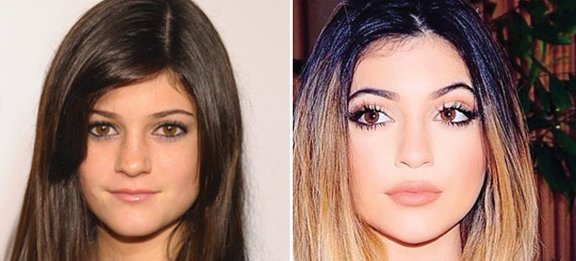 Kylie Jenner pas por el quirfano?